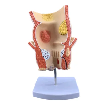 анатомична човешка ректума патология лезия модел хемороиди ануса медицински учебни материали